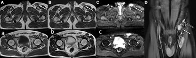 Kimura disease, a rare cause of inguinal lymphadenopathy: A case report